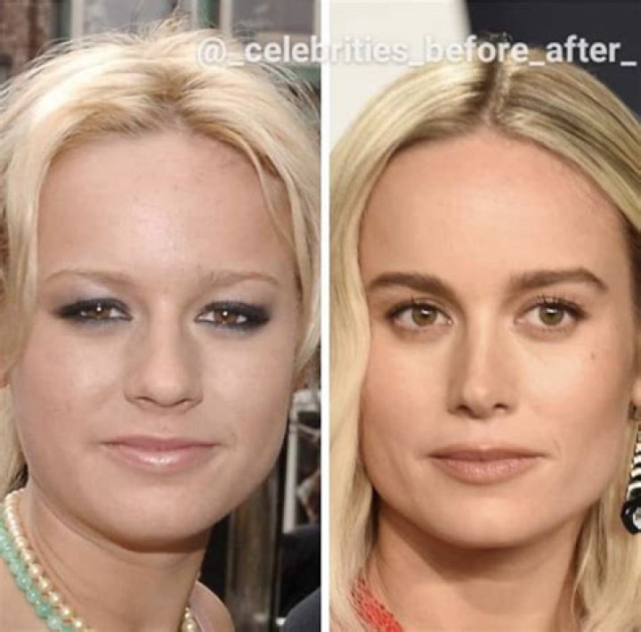 Ashton Kutcher Nose Job Plastic Surgery Before and After