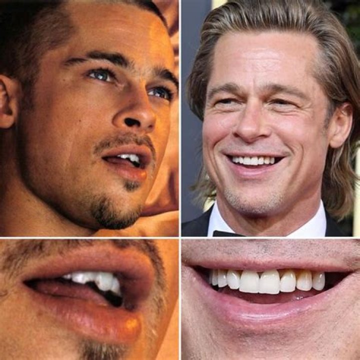 Can You Eat And Drink With Clip In Veneers? – Celebrity