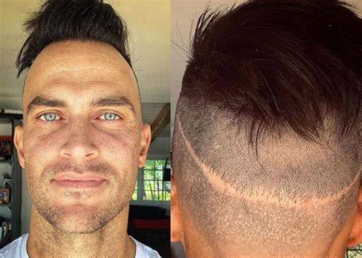 Cheyenne Jackson Shows Off Massive Hair Transplant Scar — Ouch!