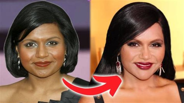 Did Mindy Kaling have plastic surgery?