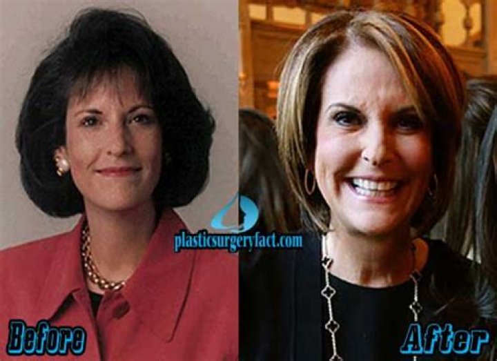 Gloria Borger Plastic Surgery: Gloria's Changing Appearance and Reaction to The Rumors Explored!