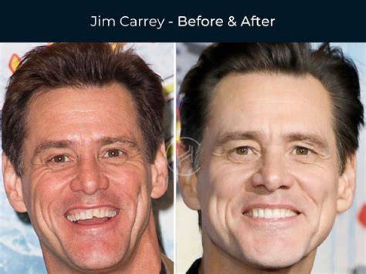 Jim Carrey Chipped His Tooth Again For Dumb And Dumber To