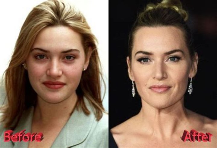 Kate Winslet Plastic Surgery: Embracing Age and Defying Hollywood Norms