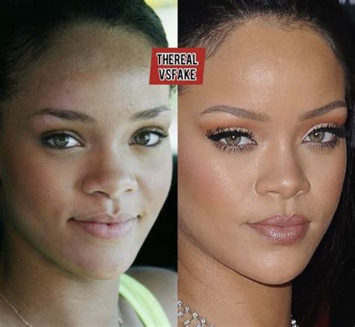 Rihanna Nose Job Plastic Surgery Before and After