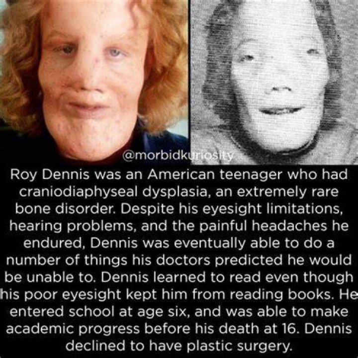 Rocky Dennis – Bio, Facts, Family Life, Disease, Death