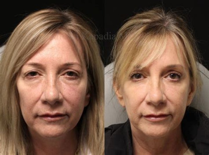 See before and after surgery photos