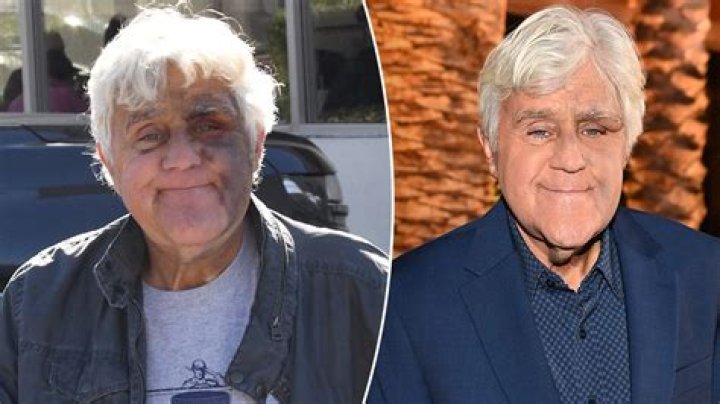 What disorder does Jay Leno have? – Celebrity